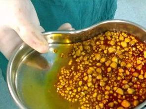 胆囊发炎可以吃瓜吗,瓜类食物的食用指南